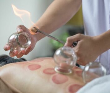 cupping acupuncture 